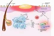 Researchers identify cellular pathways whose dysregulation leads to acne lesions