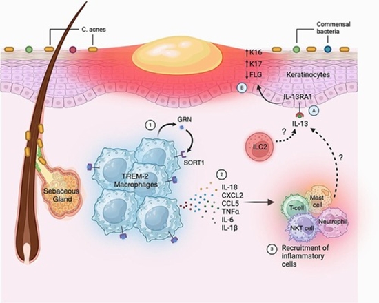Researchers identify cellular pathways whose dysregulation leads to acne lesions 