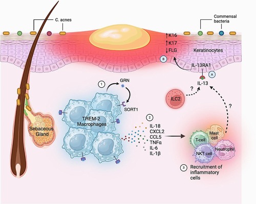 Researchers identify cellular pathways whose dysregulation leads to acne lesions
